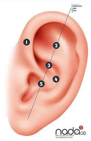 NADA Protocol - A Five Point Ear Protocol Without The Need For A Full Acupuncture Consultation