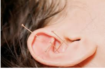 NADA Protocol - A Five Point Ear Protocol Without The Need For A Full Acupuncture Consultation