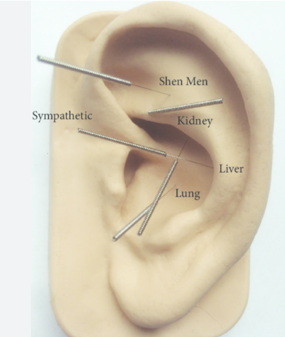 NADA Protocol - A Five Point Ear Protocol Without The Need For A Full Acupuncture Consultation